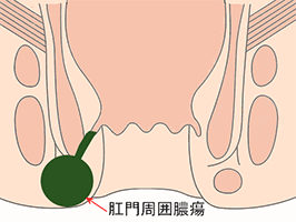 肛門周囲膿瘍のイラスト