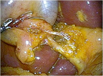 腹腔鏡下胆のう摘出術の様子