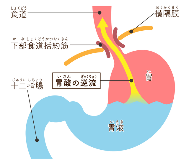 逆流性食道炎の状態